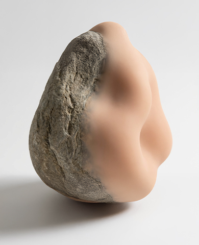 Axillary Hidradenitis Suppurativa: A Comparison between Two Perforator Flap Reconstructive Approaches after Radical Surgical Management